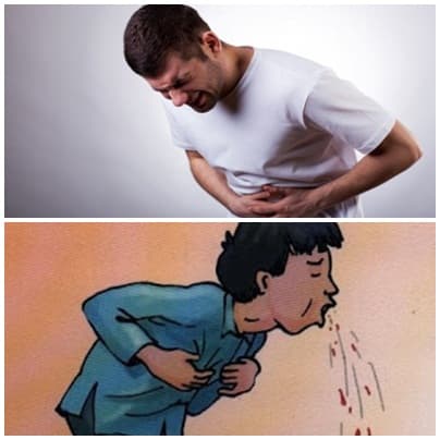 Nôn ra máu và đi ngoài phân đen hoặc có lẫn máu là triệu chứng điển hình của xuất huyết hiêu hóa.