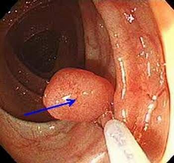Polyp đại tràng khiến người bệnh có thể bị chảy máu bất cứ lúc nào