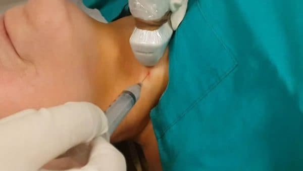 Chọc sinh thiết tuyến giáp có giá trị chẩn đoán ung thư cao