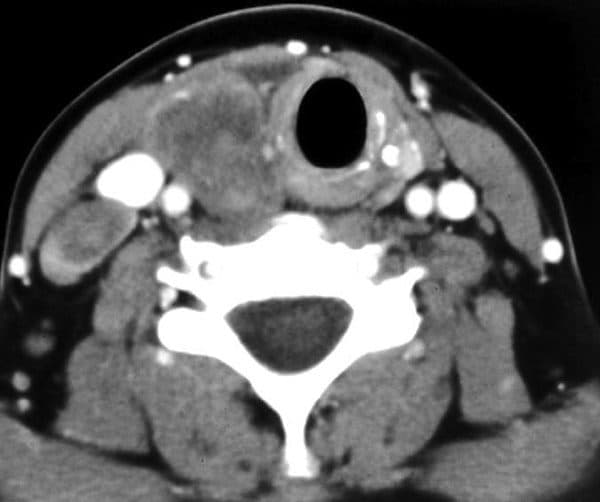 chụp cắt lớp tuyến giáp