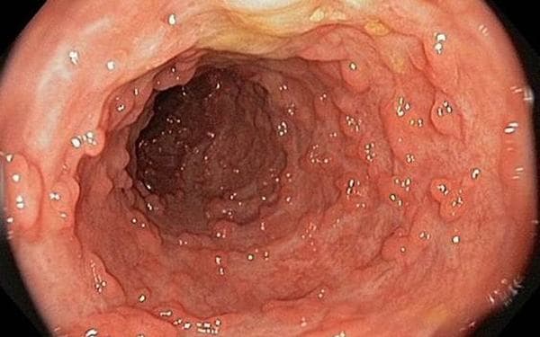 U thực quản lành tính thường không cần điều trị, chỉ cần theo dõi theo chỉ định của bác sĩ