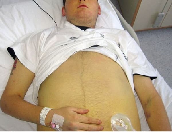 Gan to, sốt vừa hoặc cao... là những triệu chứng khi bị ung thư gan giai đoạn cuối