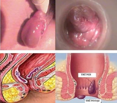 Hậu môn trực tràng sa xuống