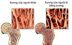Loãng xương đang ngày càng gia tăng trong cộng động