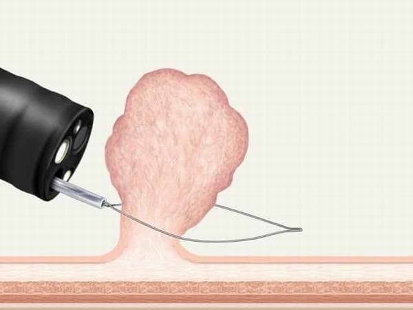 Cắt polyp dạ dày bằng phương pháp nội soi an toàn, hiệu quả cao