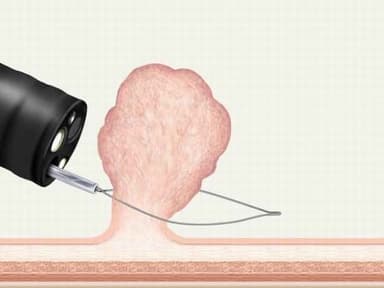 Mổ cắt polyp dạ dày ở đâu?