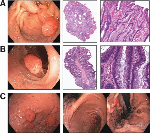 Những trường hợp polyp có kích thước lớn hoặc đa polyp có nguy cơ hình thành ung thư cần phẫu thuật cắt bỏ sớm