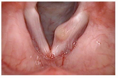 U nang thanh quản cần được phát hiện sớm và điều trị đúng cách