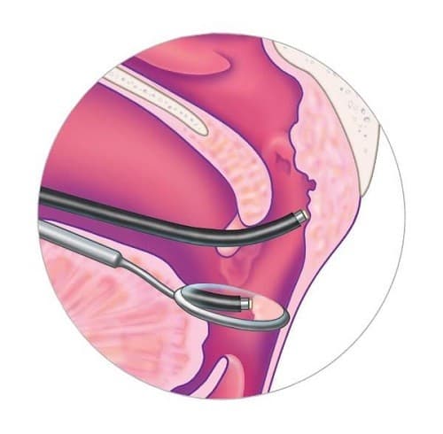 Nạo VA bằng dao plasma có nhiều ưu điểm