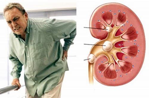 Sỏi thận gây đau đớn cho người bệnh cần được phát hiện sớm và điều trị kịp thời hiệu quả