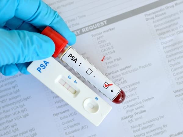 PSA (Prostate Specìic Antigen) là một kháng nguyên đặc hiệu của tuyến tiền liệt