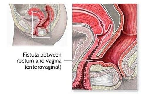 Rò trực tràng và những điều cần biết