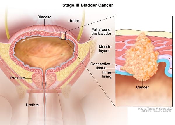 U bàng quang ác tính (ung thư bàng quang) khởi phát từ khối u phát triển ở bàng quang