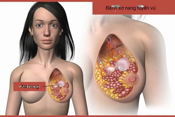 U xơ nang tuyến vú có nguy hiểm không là băn khoăn chung được nhiều người đặt ra