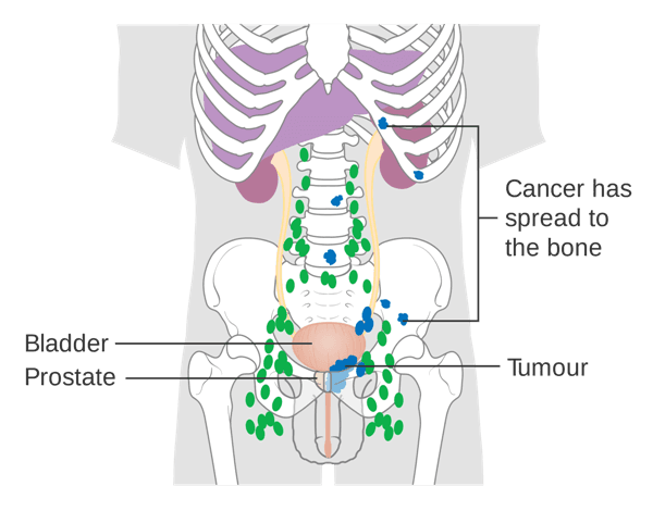 Ung thư có gây đau không là câu hỏi nhiều người quan tâm