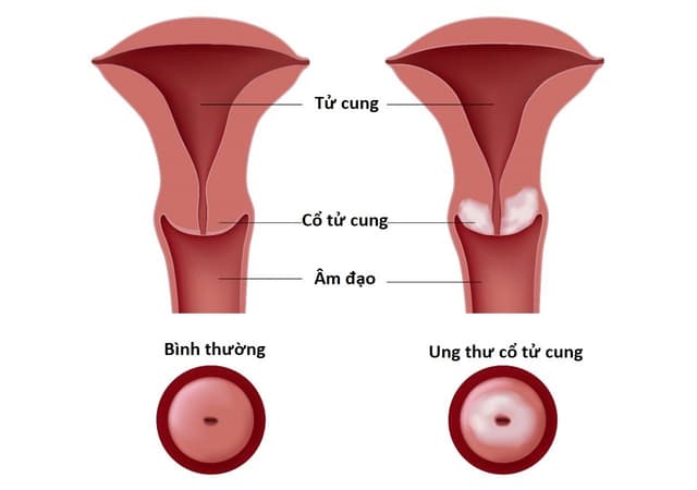 Ung thư cổ tử cung biểu hiện như thế nào?