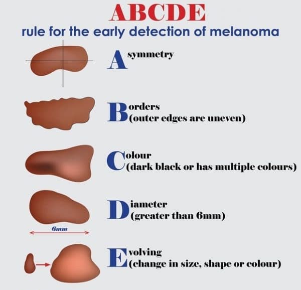 Triệu chứng của ung thư da hắc tố