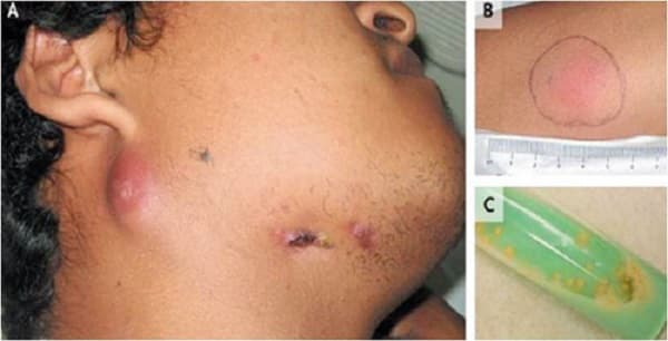 người mắc bệnh lao hạch