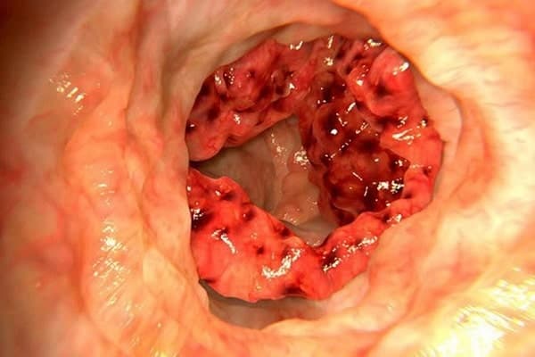  người bị ung thư đại tràng 