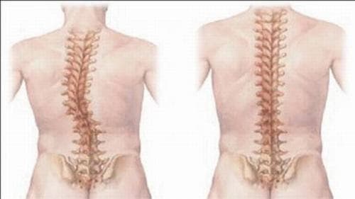 Vi khuẩn lao tấn công vào các xương lớn trên cơ thể