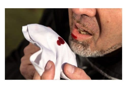 Nôn ra máu là một trong những triệu chứng của xuất huyết tiêu hóa.