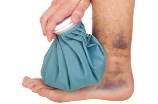 Các nhà chuyên khoa xương, khớp khuyên nên xử trí bong gân ở giai đoạn đầu theo phương pháp “hạt gạo” – RICE