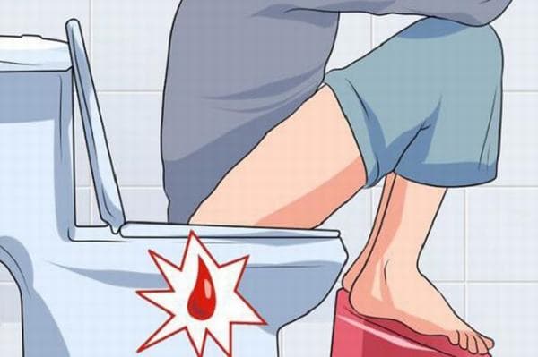 Chảy máu trực tràng có thể là do mắc bệnh trĩ