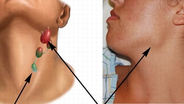 Ung thư dạ dày di căn là giai đoạn cuối của bệnh và có thể di căn tới nhiều vị trí như hạch, gan, phổi...