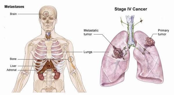 Ung thư phổi di căn thường phát triển từ giai đoạn cuối. 