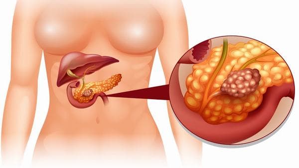 Ở giai đoạn IV là giai đoạn tế bào ung thư phát triển to, xâm lấn sang các cơ quan lân cận