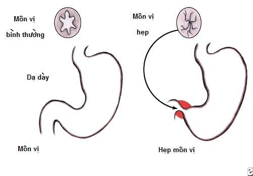Phẫu thuật là phương án điều trị phổ biến với hẹp phì đại môn vị bẩm sinh.