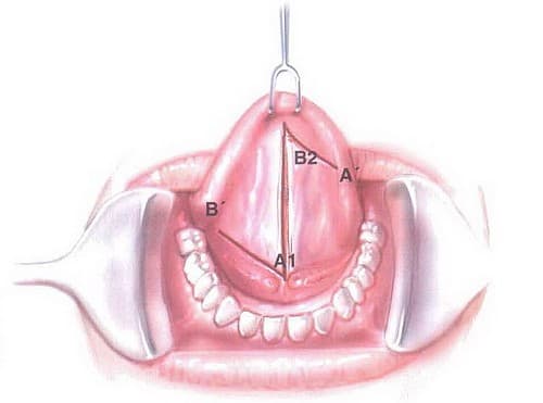 Trẻ bị dính thắng lưỡi sẽ khó bú sữa, khó nhai thức ăn, hay ngủ gật khi bú, trẻ nói ngọng,...