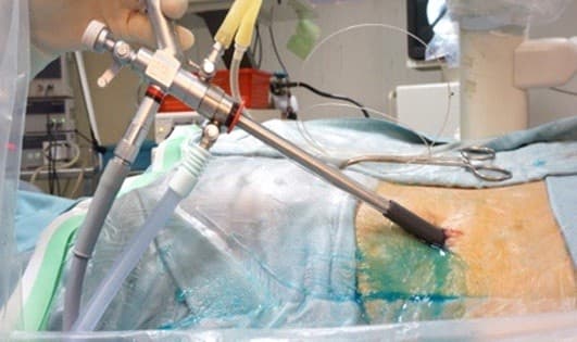 Tán sỏi qua da là phương pháp điều trị sỏi niệu kích thước lớn tốt nhất hiện nay, hoàn toàn thay thế cho mổ mở. 