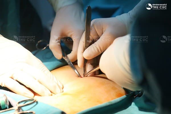 Bệnh viện Thu Cúc có phòng mổ vô khuẩn 1 chiều với trang thiết bị hiện đại nhất, đảm bảo phẫu thuật an toàn cho người bệnh