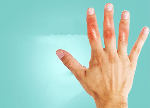 Vì sao đầu ngón tay bị sưng và ngứa?