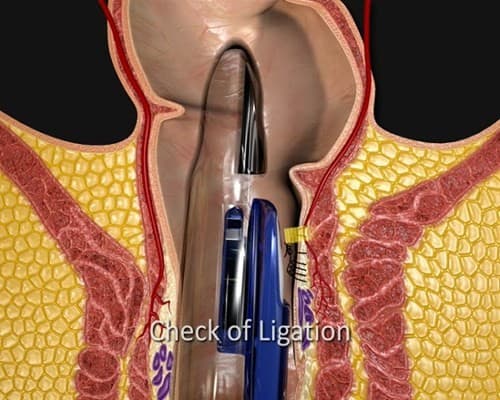 Thắt mạch khâu treo búi trĩ là một trong các phương pháp điều trị bệnh trĩ 