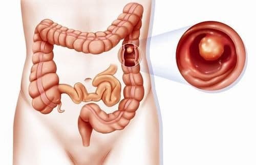 Trẻ có polyp đại tràng, bệnh thường thể hiện qua các triệu chứng như đi ngoài phân lẫn máu tươi xuất hiện ở cuối bãi.