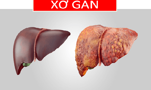 Khi các mô xơ xâm chiếm từ 50% lá gan trở lên thì được gọi là xơ gan. 