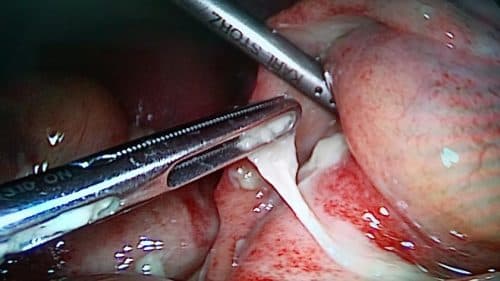 Mổ nội soi được áp dụng phổ biến trong điều trị viêm phúc mạc ruột thừa hiện nay.