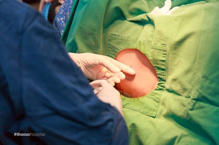 Đẻ không đau thực chất là gây tê màng cứng