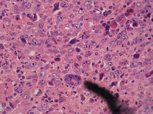 Bệnh Hodgkin là gì