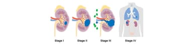 Các giai đoạn ung thư thận bạn cần biết