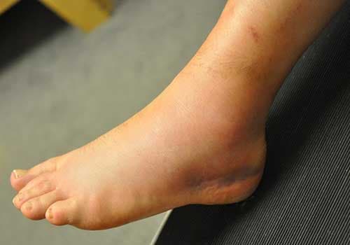 Cách chữa trẹo chân nhanh khỏi nhất