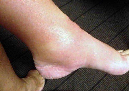 Hình ảnh bị trẹo chân