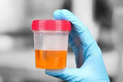 Chỉ số LEU 500 trong nước tiểu là gì và có ý nghĩa gì