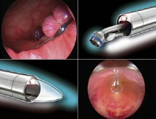 Có nên thắt búi trĩ không là thắc mắc của nhiều người bệnh khi lựa chọn cách điều trị căn bệnh này.