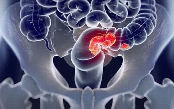 Ung thư đại tràng xảy ra khi các tế bào ung thư xuất hiện ở các vị trí trên đại tràng.