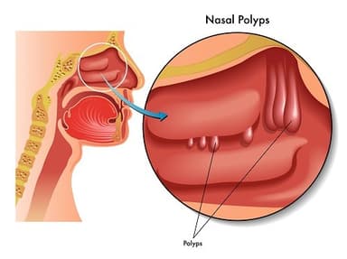 Điều trị polyp mũi như thế nào?