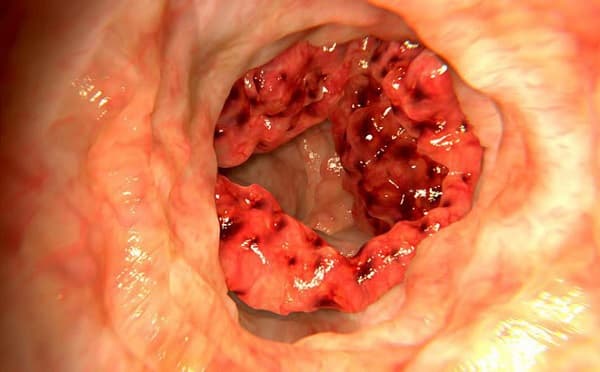 Ung thư đại tràng