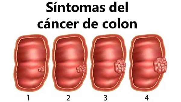 Ung thư đại tràng giai đoạn cuối là giai đoạn mà các tế bào ung thư đã xâm lấn và di căn sang nhiều cơ quan khác trong cơ thể